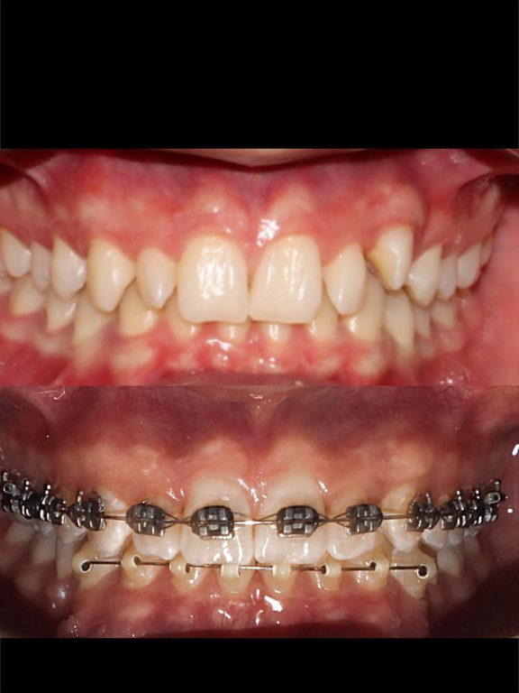 Resultado de tratamiento dental