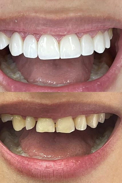 Resultado de tratamiento dental
